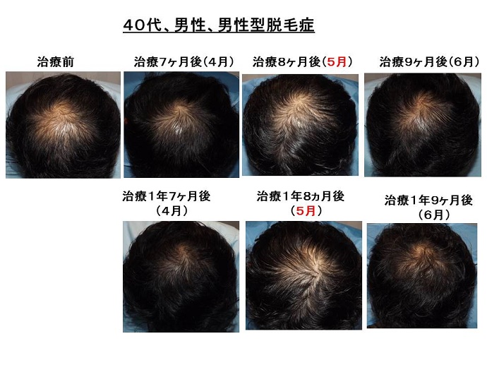 円形脱毛症　病院""